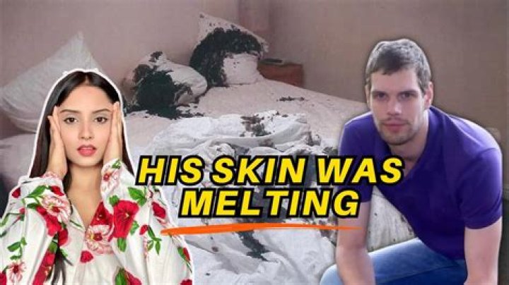
What Happened To Mark Van Dongen Face? Death Or Alive, Where Is Acid Attack Victim Now? 